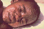 Smallpox Epidemic Strikes at the Cape